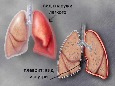 Почему болит в правом боку и отдает в спину