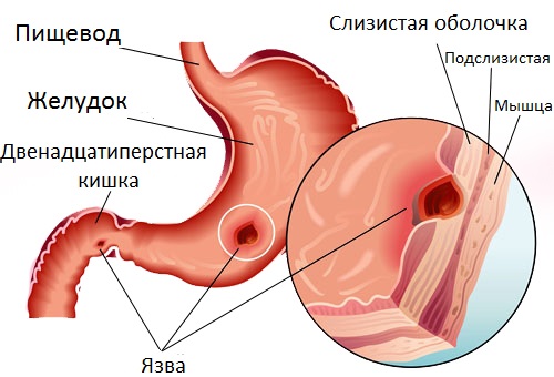 Kak vyglyadit yazva zheludka. Как выглядит язва желудка.