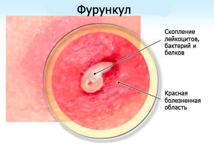 Furunkul - prichiny i lecheniye Фурункул - причины и лечение