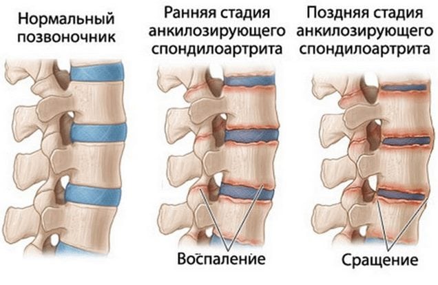 Здоровый и пораженный болезнью Бехтерева позвоночник Анкилозирующий спондилоартрит