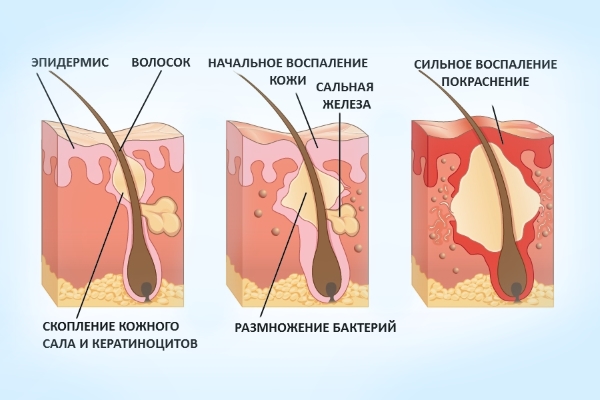 Chto takoye furunkul, pochemu poyavlyayetsya Что такое фурункул, почему появляется
