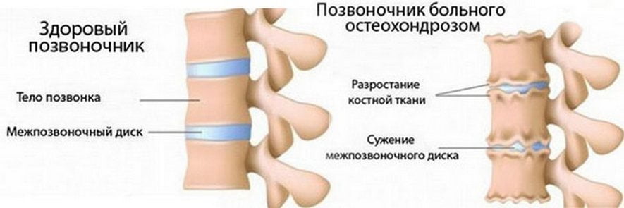 Сравнение здорового позвоночника и пораженного остеохондрозом Остеохондроз