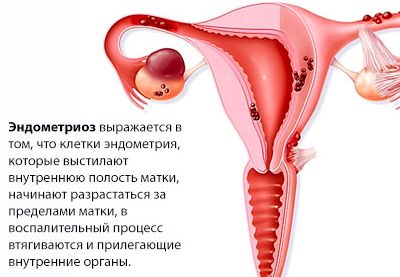 Болит низ спины после месячных