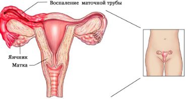 Болит низ спины после месячных