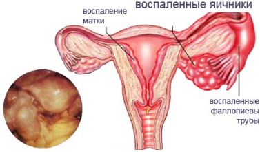 Болит низ спины после месячных