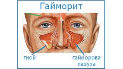 после вращения головы болит