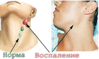 температура болит спина и шея