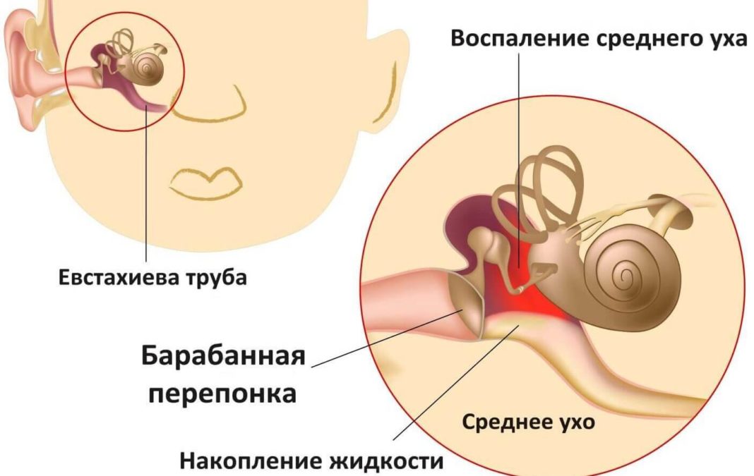 Отит Воспаление среднего уха - отит