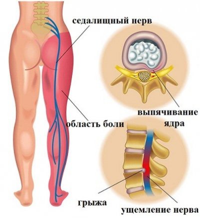 Поражение седалищного нерва