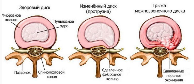 Очень сильно болит середина спины
