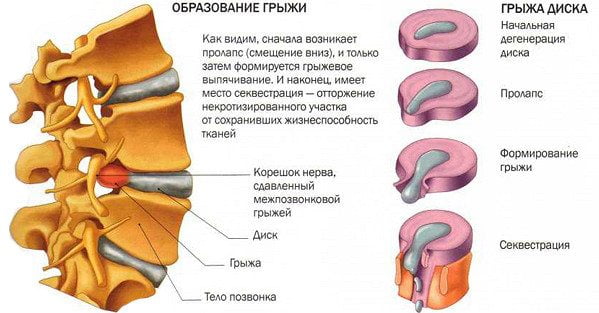 Очень сильно болит середина спины