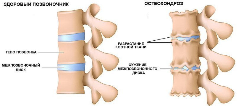 Здоровый и пораженный остеохондрозом позвоночник Остеохондроз позвоночника