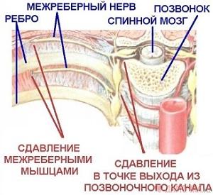 межреберная невралгия