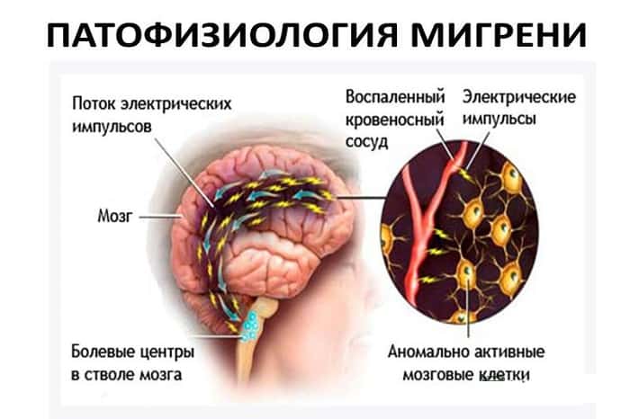 Мигрень Мигрень
