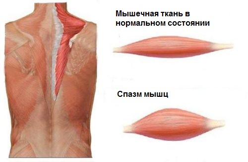 Лекарства от болей в спине мовалис