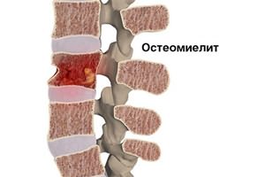 температура болит спина и шея