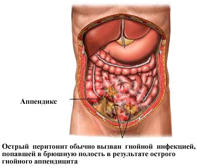 Болит низ спины после месячных