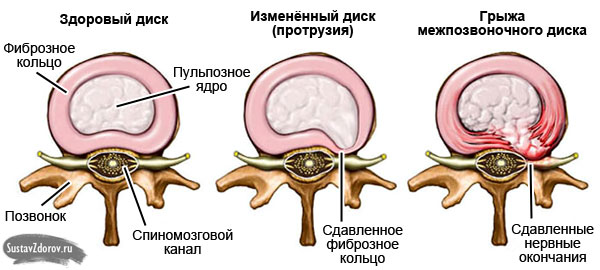 искупался в холодной воде болит спина