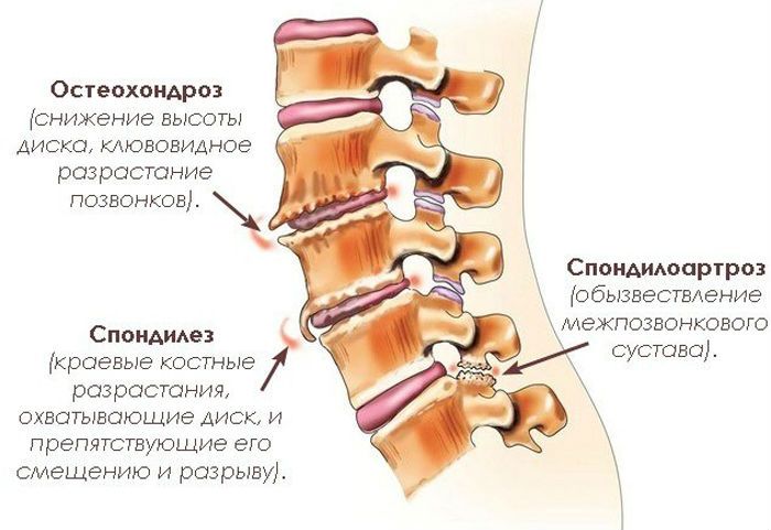 Что такое деформирующий спондилез