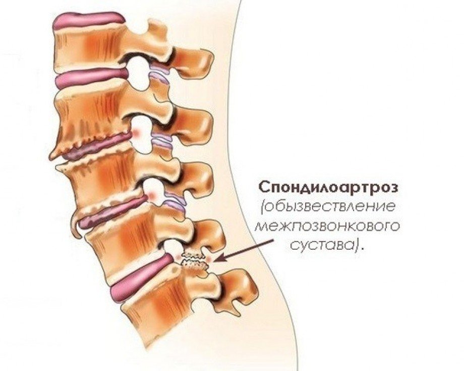 Спондилоартроз позвоночника
